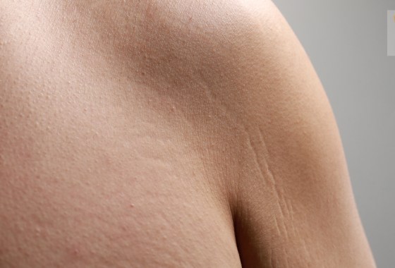 How to get rid of stretch marks (skincare)